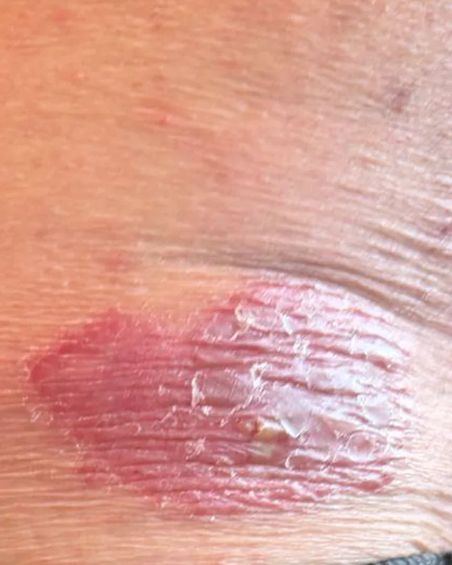Cropped abdomen skin in the photograph labelled 6 July 2026, showing a textured patch