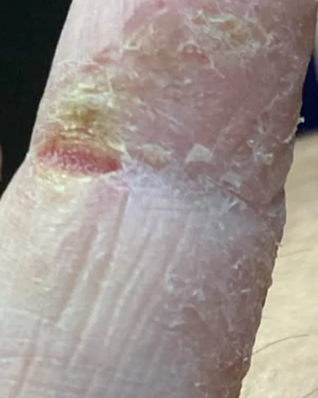 Close crop of a finger in the photograph labelled 6 August