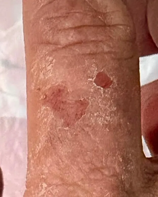Close crop of a finger in the Day 0 photograph