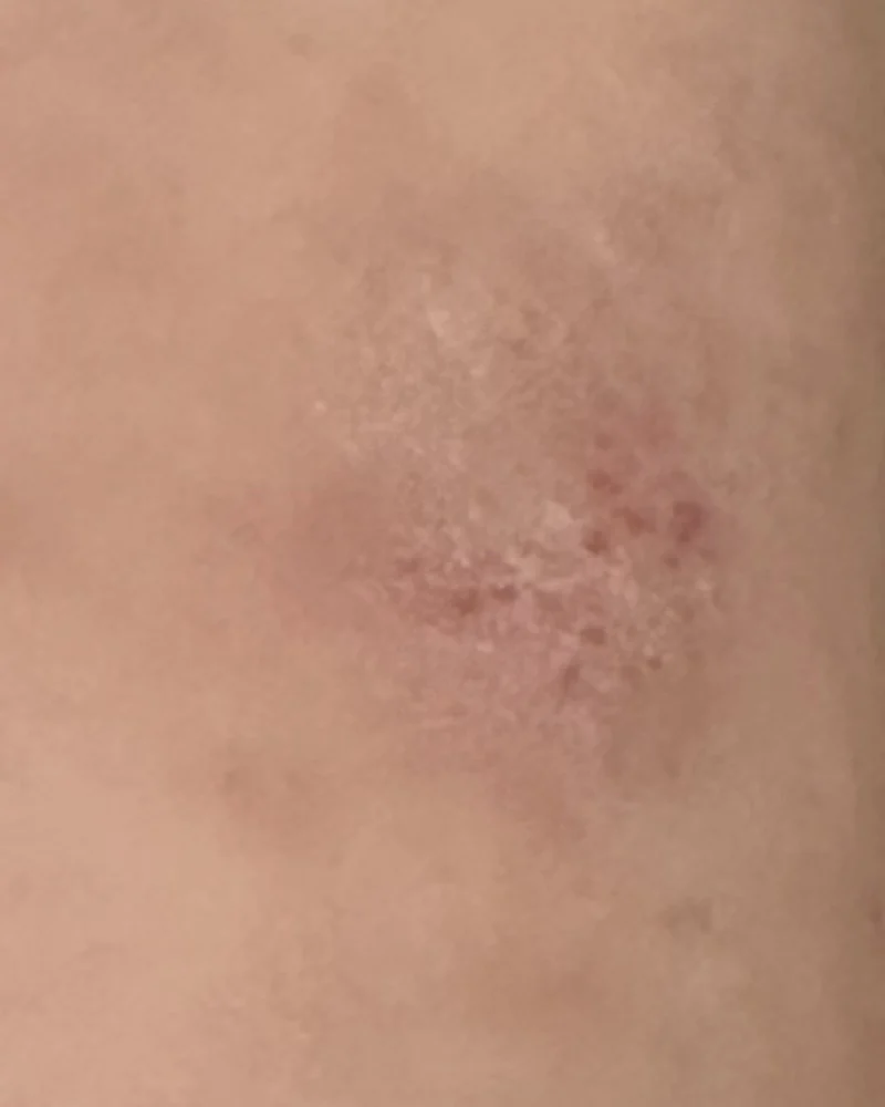 Close crop of left inner-elbow skin photographed on 11 July 2026