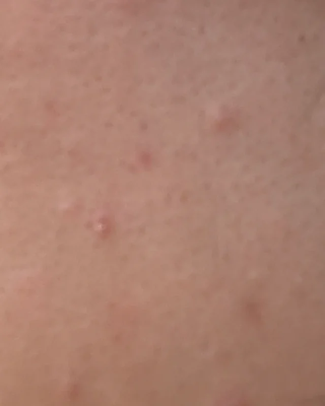 Skin-only crop of the left cheek at intake, with a few visible blemishes