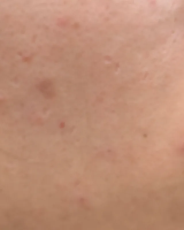 Close crop of right cheek skin at intake