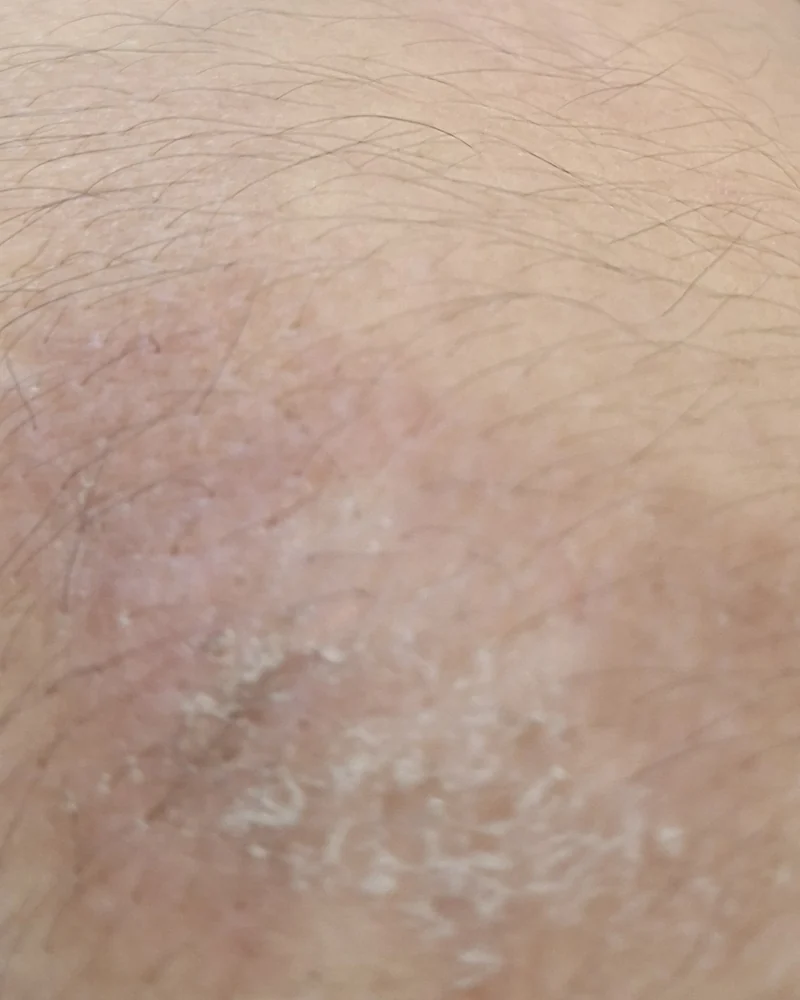 Skin-only crop of a textured patch on the left upper arm on 25 August