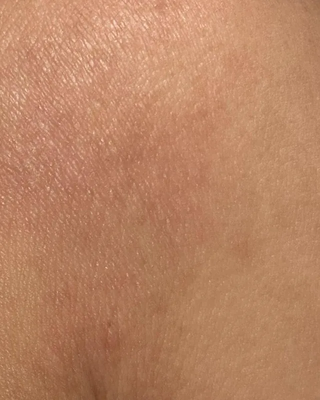 The same upper-arm area photographed on 10 August 2026
